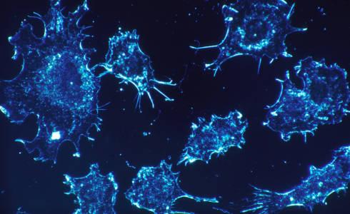 Sinisiä syöpäsoluja mikroskooppikuvassa.